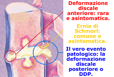 Tipi di deformazioni discali